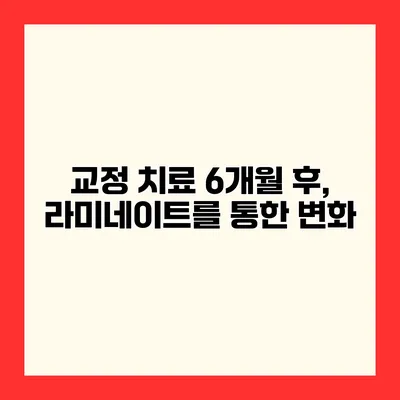 교정 치료 6개월 후, 라미네이트를 통한 변화