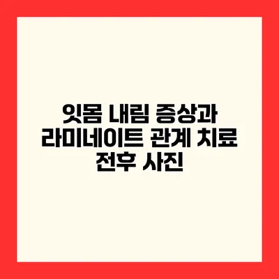 잇몸 내림 증상과 라미네이트 관계 치료 전후 사진